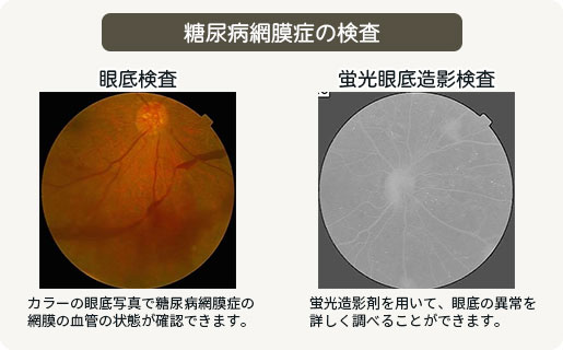 糖尿病網膜症の検査画像