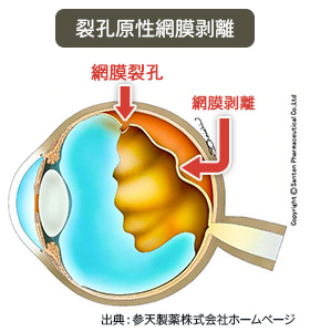 裂孔原性網膜剥離