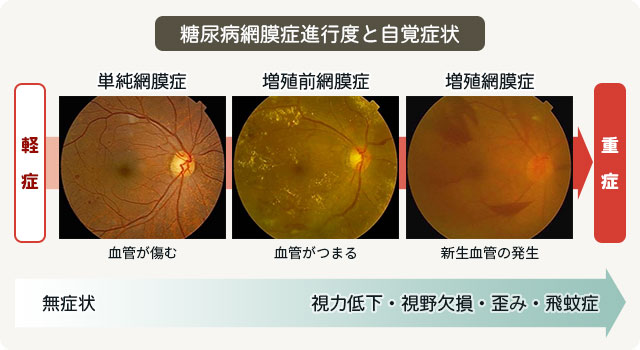 糖尿病網膜症進行度と自覚症状