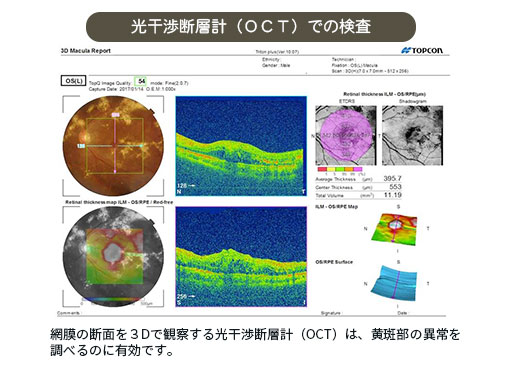 光干渉断層計（OCT）検査画像