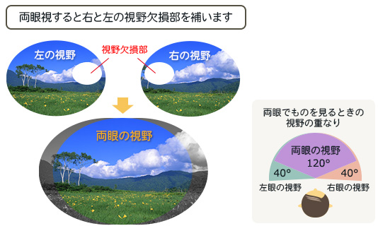 両眼視すると右と左の視野欠損を補います