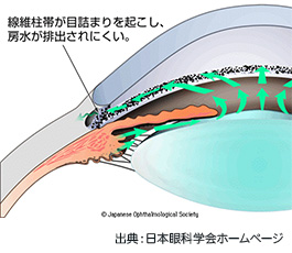 開放隅角緑内障