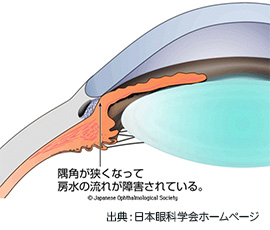 閉塞隅角緑内障